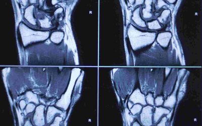 Comparison of magnetic resonance imaging quality between hard and soft coils of shoulder joint