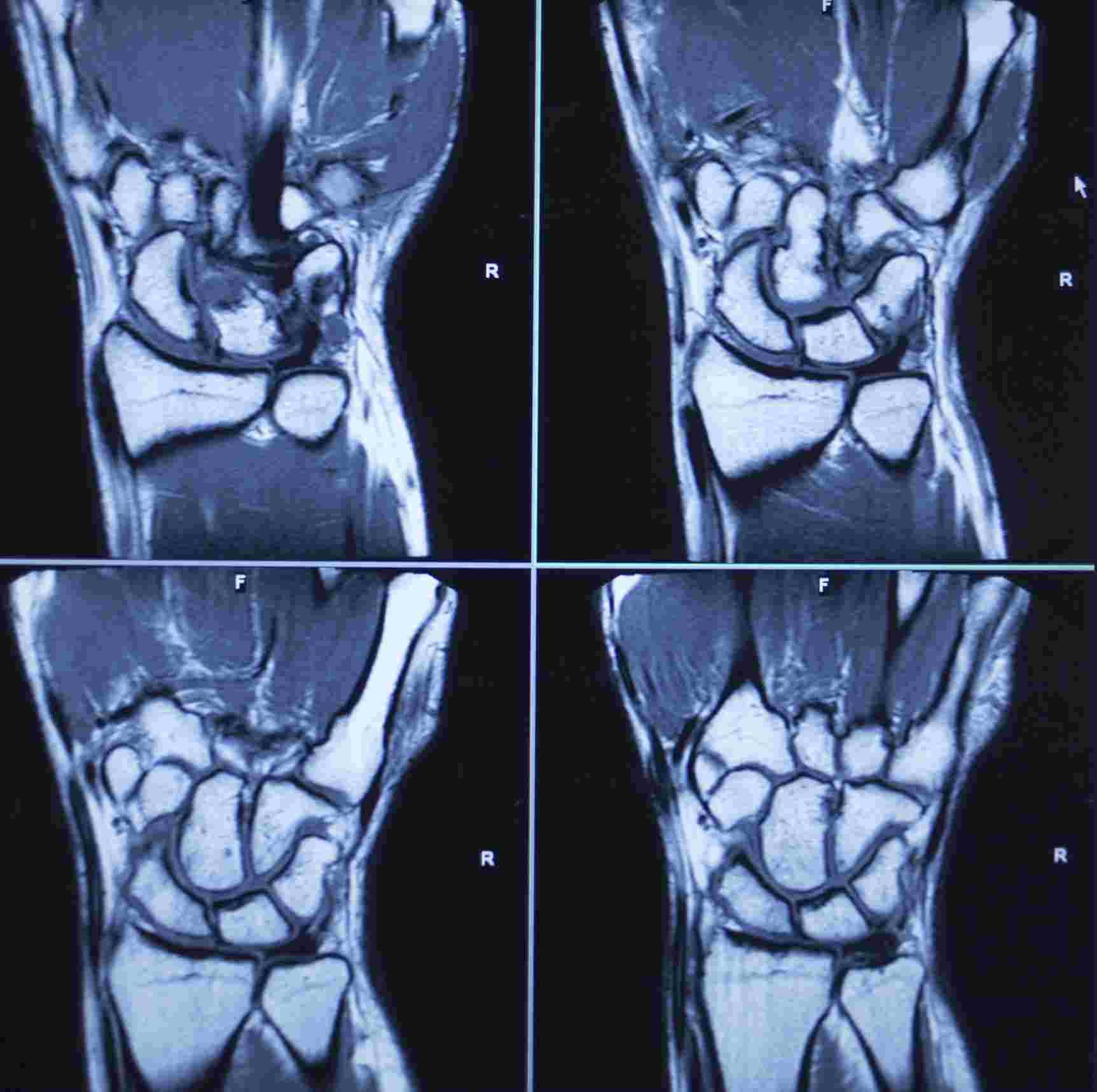 Comparison of magnetic resonance imaging quality between hard and soft ...